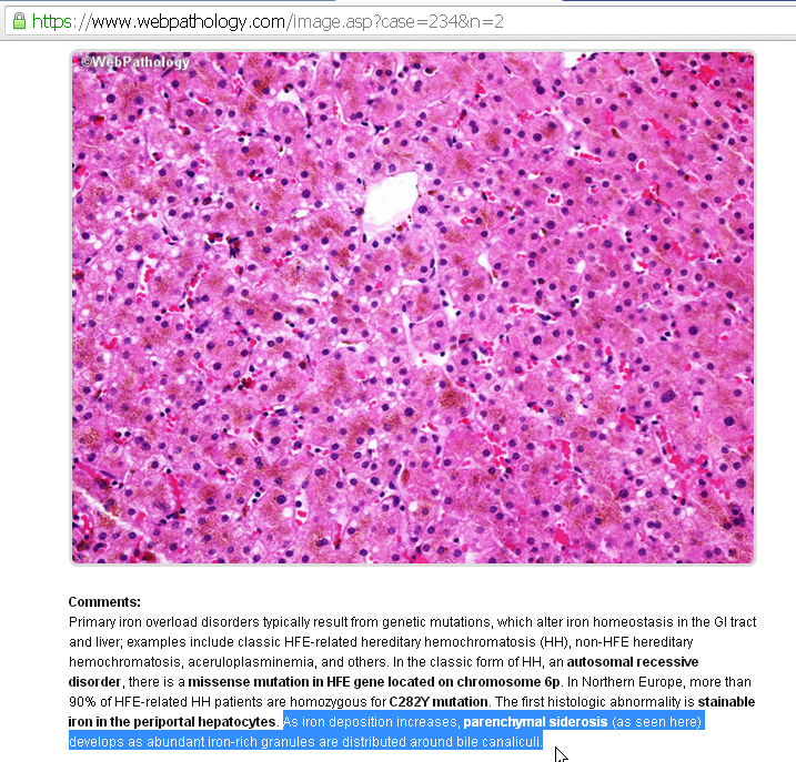 Parenchymal siderosis develops as abundant iron-rich granules around bile canaliculi.